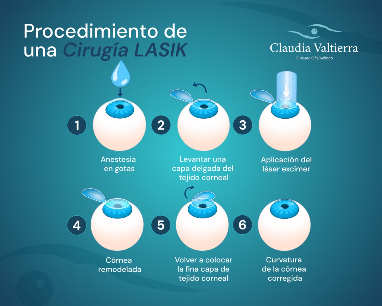 ¿Soy candidato a cirugía láser de ojos?